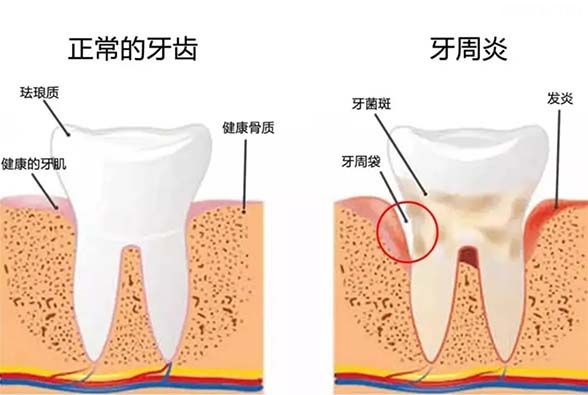 牙周炎的5大危害(要坚持早晚刷牙)