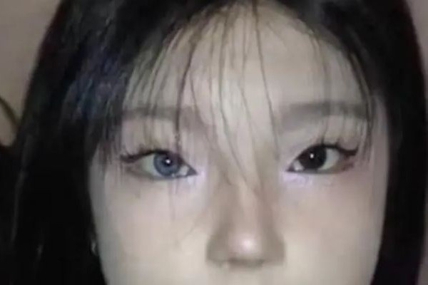 18岁女孩右眼天生蓝瞳 为什么有的人瞳孔颜色不一样
