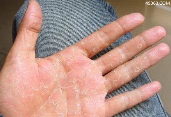 手脱皮是什么原因导致的?