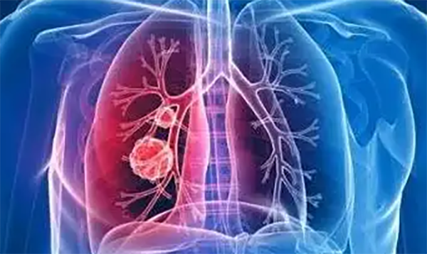 肺癌晚期最怕三个征兆(出血、胸闷呼吸困难、意识不清)