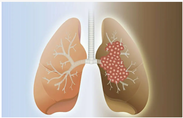 肺癌晚期最怕三个征兆