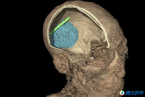 揭秘木乃伊制作之谜：利用鼻子获得脑组织