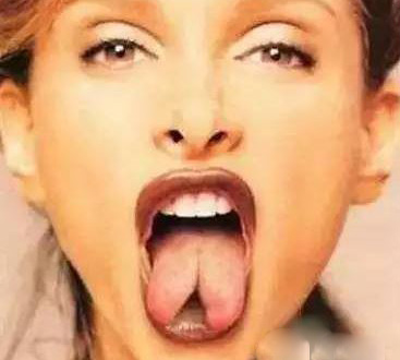 巴黎34岁女子长着两个舌头