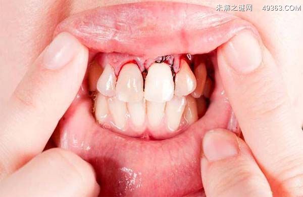 牙龈出血要警惕三种病，口腔疾病/全身性疾病/压力大