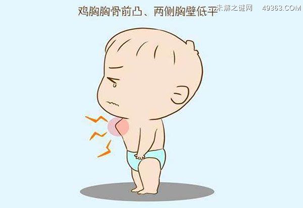 鸡胸人和正常人区别