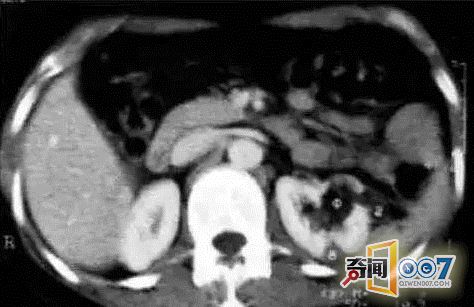 四只肾